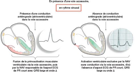 Chapitre Item Palpitations Soci T Fran Aise De Cardiologie