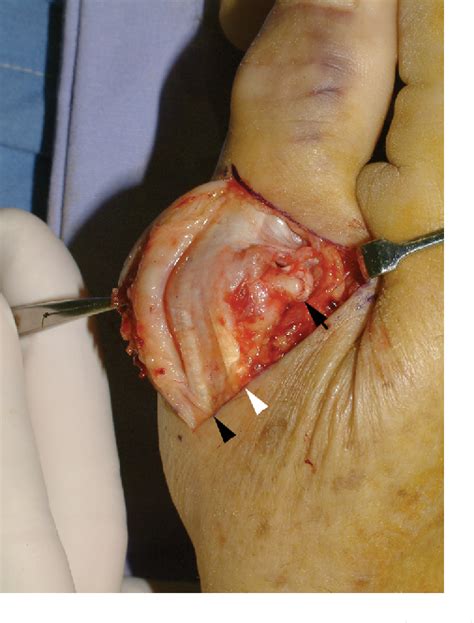 Figure 2 From Palmar Dislocation Of The Thumb Metacarpophalangeal Joint