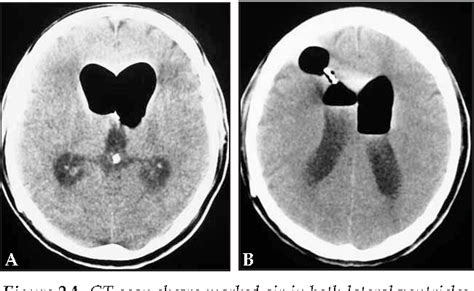 Figure From Delayed Intraventricular Tension Pneumocephalus Due To