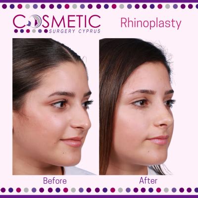 Ultrasonic Rhinoplasty Abroad Benefits Cosmetic Surgery Abroad