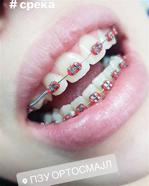 Top 10 colored of red braces for handsome teenage boys | Braces Explained