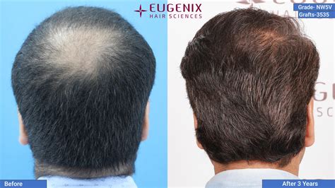 Norwood Scale 5v Baldness Hair Transplant And Treatment Uk