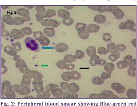 Figure From A Study Of Rapid Leishman Stain On Peripheral Blood Smear