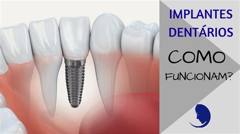 IMPLANTES DENTÁRIOS COMO FUNCIONAM YouTube