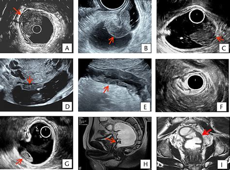 The Value of Transanal Normal Saline Infusion–Assisted Multi... : Ultrasound Quarterly