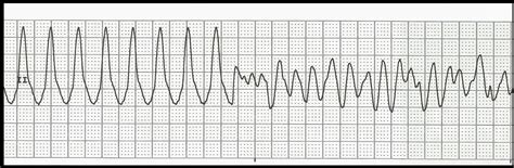 Float Nurse: Practice Rhythm Strips 250