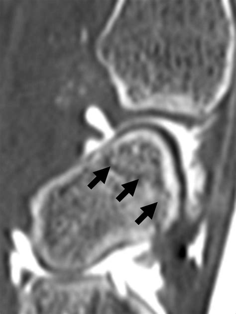 Multidetector Ct Arthrography Of The Wrist Joint How To Do It