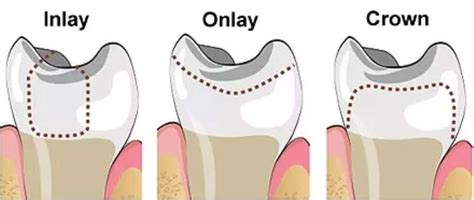 Dental Filling, Dental Inlay & Onlay Singapore | Dennis Tan Dental Surgery