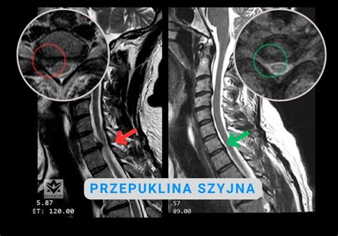 Jak Rehabilitowa Przepuklin Szyjn Kr Gos Upa Rehmedis Pl