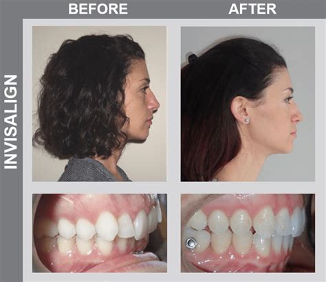 Smile Gallery Before And Afters Ncoso Orthodontics