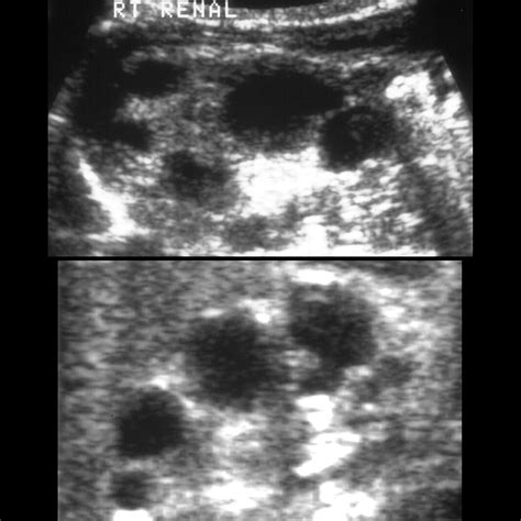 Newborn with a cystic kidney on prenatal ultrasound | Pediatric