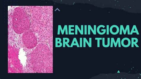 Meningioma Brain Tumor Causes Symptoms Diagnosis Stages Treatment