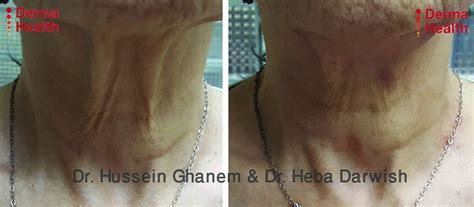 Before And After Photos Prof Hussein Ghanem