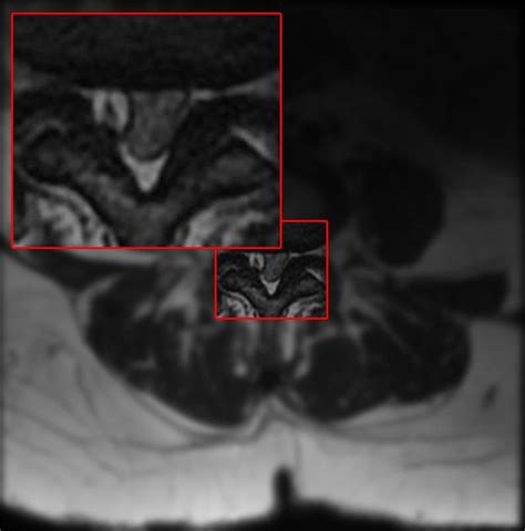 Synovial Cyst Lumbar Spine Surgery