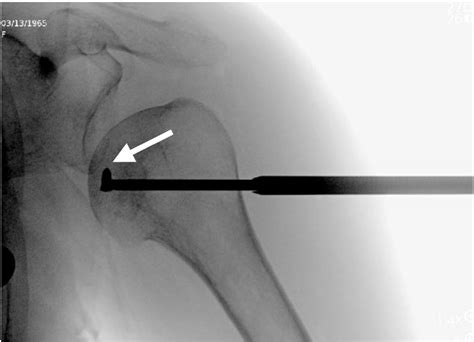 Figure From Arthroscopic Assisted Intraosseous Bioplasty Of The