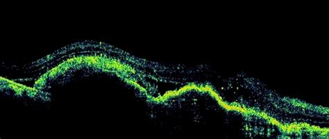 Advanced Wet AMD - Retina Image Bank