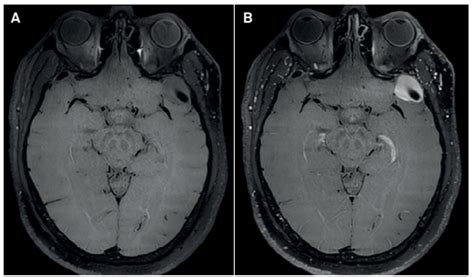 Scielo Brasil Intracranial Isolated Varix Mimicking A Meningioma