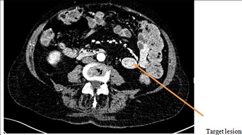 Jejunal Intussusception A Cause Of Upper Gastrointestinal Bleeding Bmj Case Reports