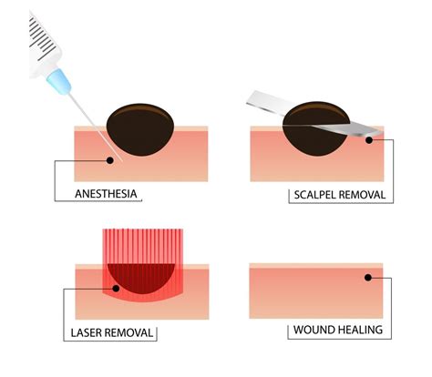 mole removal procedue 01 - The HealthUp