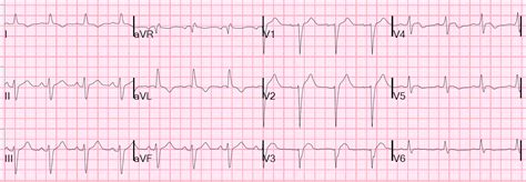 Dr Smith S Ecg Blog Chest Pain With New Lbbb It Helps To Actually