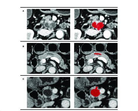 Examples Of Different Patients In The Venous Phase Tumor Regions Were