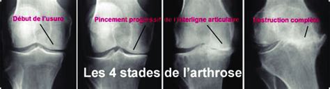 Clichés de face en radiologie simple montrant les 4 stades de