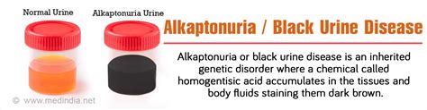 Alkaptonuria Black Urine Disease Causes Symptoms Diagnosis