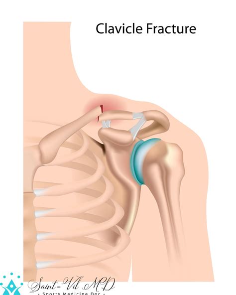 Clavicle fracture - ExerciseNow