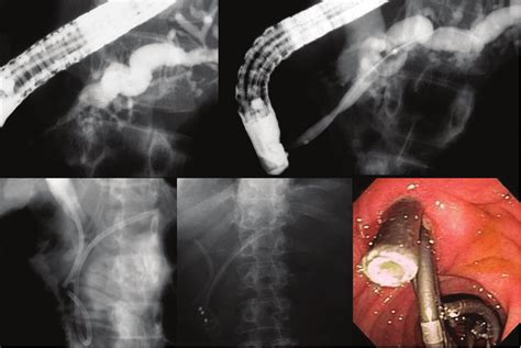 The Procedure Of Endoprothesis Insertion For The High Grade Pancreatic Download Scientific