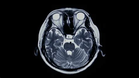 Close up of CT scan of brain anatomy hea... | Stock Video | Pond5