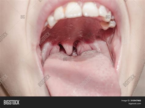 Larynx Throat Glands Image Photo Free Trial Bigstock