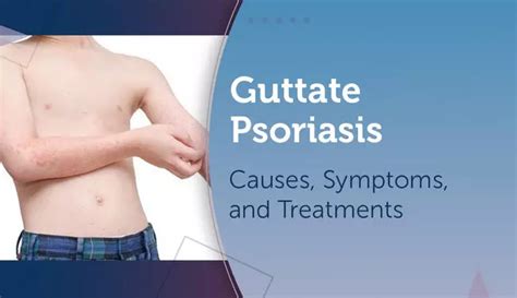 Guttate Psoriasis: Causes, Symptoms, and Treatments | MyPsoriasisTeam