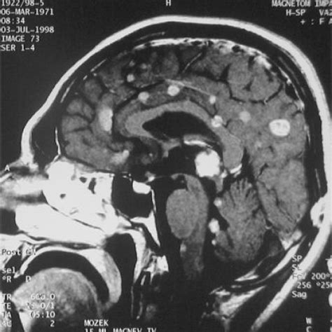 Pineoblastoma | Eurorad