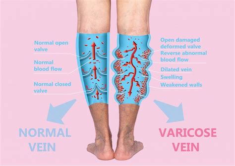 Vein Treatments Vein Specialists Of The Carolinas Treat Thousands Yearly