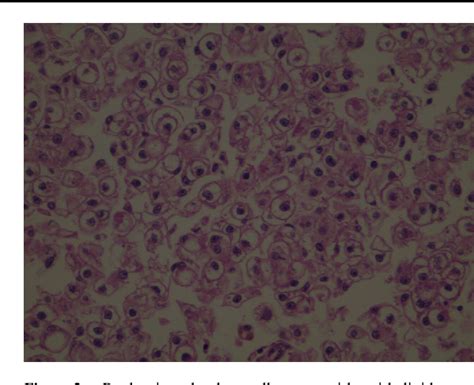 Figure 2 From Malignant Hepatic Perivascular Epithelioid Cell Tumor