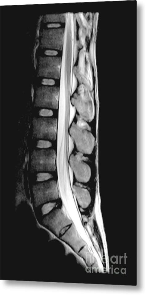 Healthcare Extreme How To Read An MRI Lumbar Spine In Easy, 52% OFF