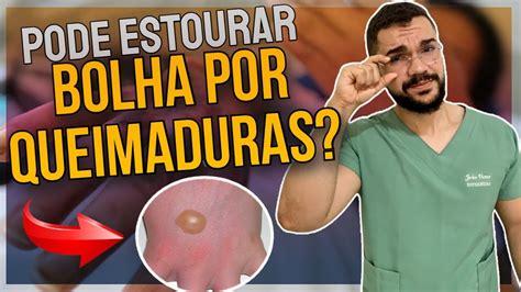 BOLHA DA QUEIMADURA ESTOURA OU NÃO ENTENDA O CASO YouTube