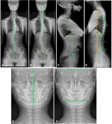 Frontiers Trunk Balance Head Posture And Plantar Pressure In