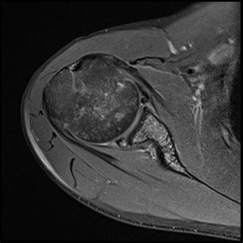 Reverse Hill Sachs And Reverse Bankart Lesions Image Radiopaedia Org