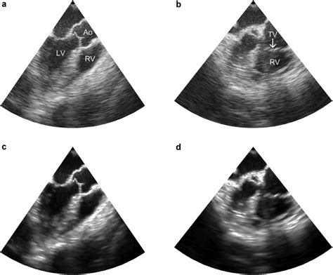 Automated Assessment Of Right Ventricular Volumes And Function Using