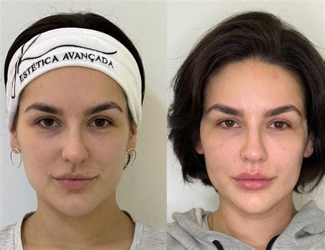 Kéfera surge em antes e depois de harmonização facial Adorei