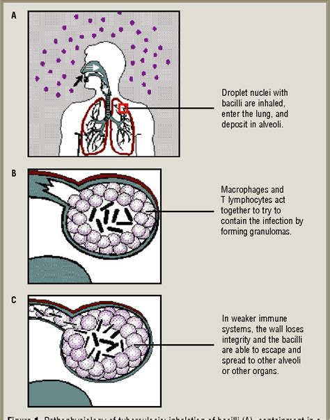 4 Stages Of Tuberculosis