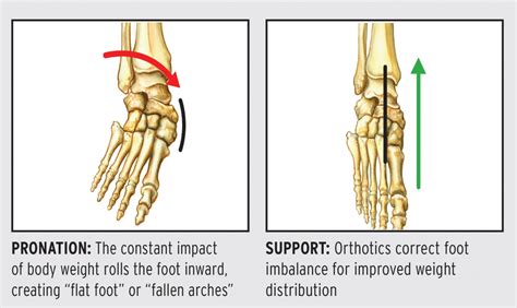 Asymmetrical Excessive Pronation And Effect On Chiropractic Adjustment