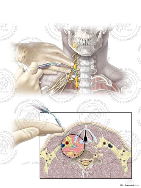 Stellate Ganglion Block Side Effects