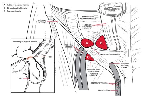 Female Internal Inguinal Ring Inguinal And Femoral Hernias Inguinal