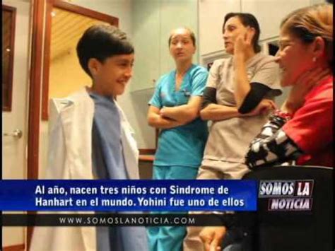 Al año nacen tres niños con Sindrome de Hanhart en el mundo Aqui la