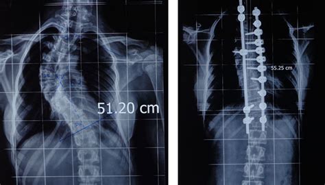 Deformity Correction