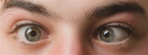 Strabismus Overview Causes Symptoms Treatment