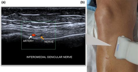 Technique For Ultrasoundguided Radiofrequency Denervation Of Genicular