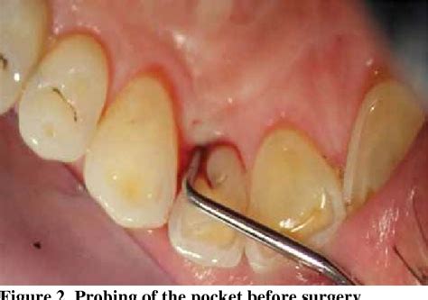 Figure 3 From Management Of A Palatal Gingival Groove In A Maxillary